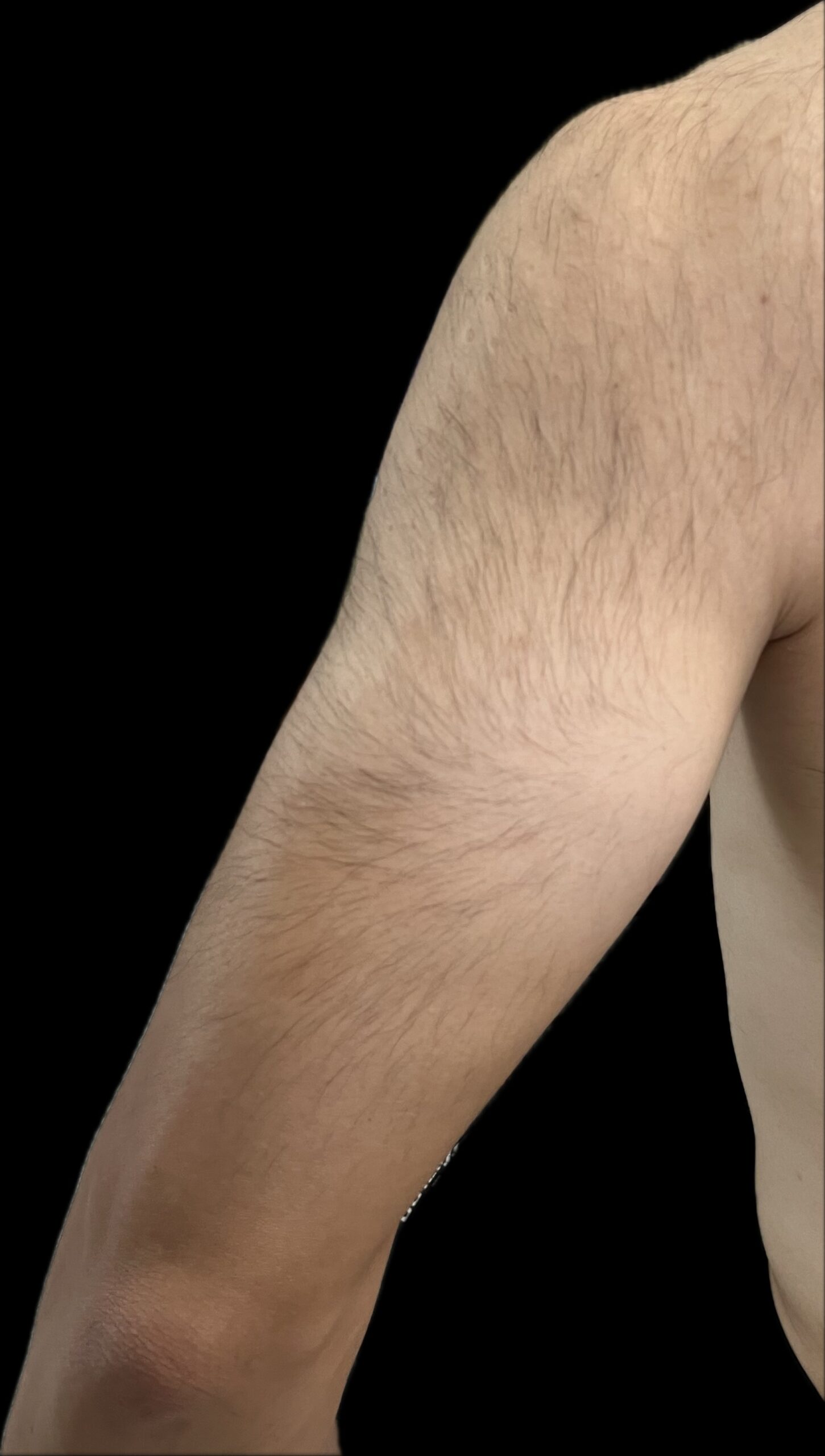 硬毛化した腕（前腕伸展側）